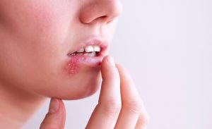 Tips for Managing a Cold Sore
