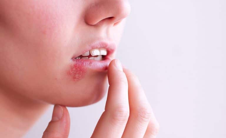 Tips For Managing A Cold Sores Natural Remedies