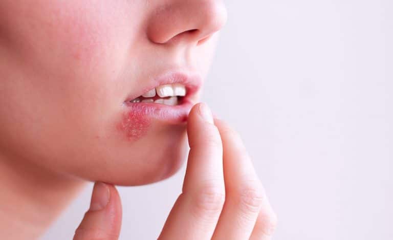 tips-for-managing-a-cold-sores-natural-remedies