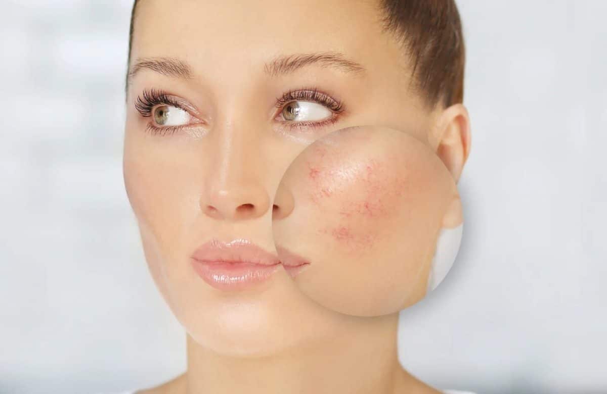 How to Manage the Symptoms of Rosacea - Face Doctor