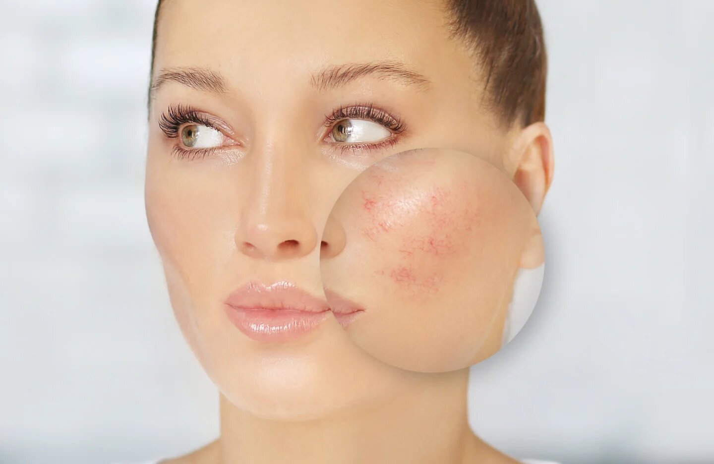 How to Manage the Symptoms of Rosacea